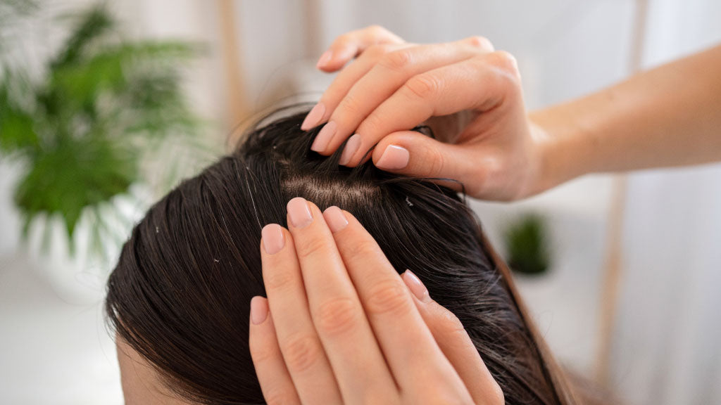 Caspa persistente: ¿Cuándo es momento de buscar tratamientos médicos?